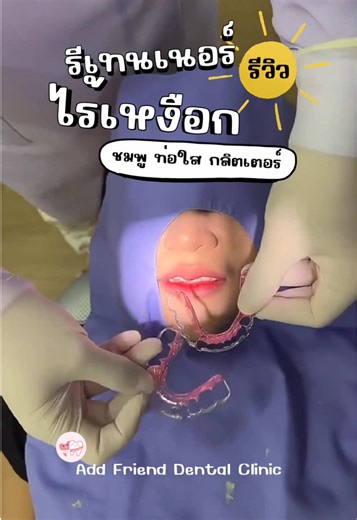 🌈รีเทนเนอร์ไร้เหงือก🌈 🌸จัดฟันที่อื่นก็ทำรีที่เราได้ 🌸ถอดเครื่องมือจากที่อื่น 1333 .- มีฟันคุดก็ทำได้ ✨ราคา 3,000.-/2 ชิ้น ✨ฟรีพิมพ์ฟัน ✨ฟรีใส่ Glitter 🦷เติมฟันซี่ละ 300 🌈สนใจติดต่อได้ที่ Add Friend Dental Clinic ทั้ง 4 สาขา -สาขาพญาไท -สาขาราชพฤกษ์ -สาขาท่าพระ -สาขาศาลายา #คลินิกทันตกรรม #รีเทนเนอร์ #รีเทนเนอร์ไร้เหงือก #รีเทนเนอร์โลหะ #รีเทนเนอร์ท่อสี