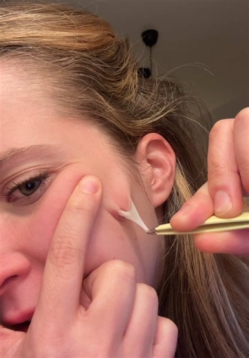 Effective Pimple Patches for Acne Management