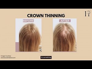 Crown Thinning Hair: How to Stop & Reverse It!