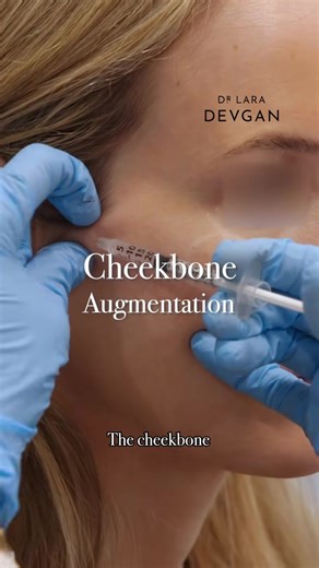 Cheekbones account for nearly 70 percent of what we read as facial beauty because they function as the structural “spotlight” of the midface, shaping how light reflects, how the face photographs, and how youthful definition is perceived at first glance. High, well-supported cheekbones create a natural lift through the central face, subtly elevating the lower eyelid and softening heaviness around the nasolabial fold, while also giving the face a sculpted contour without looking sharp or artificia