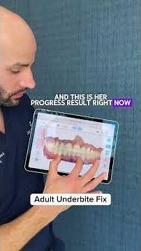 I have an underbite. Can Invisalign fix it?