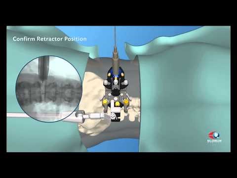 Lateral Lumbar Interbody Fusion (LLIF) Technique