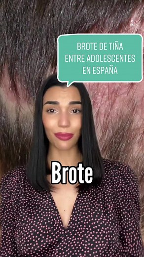 Brote de Tiña entre Adolescentes en España