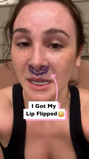 37K views · 143 reactions | Getting plastic surgery on my lips  | Four Nine | Facebook