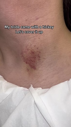 How to Cover a Hickey with Makeup: Step-by-Step Guide