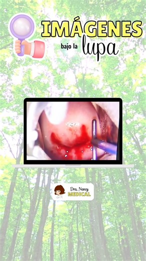 CONIZACIÓN CERVICAL 🔍 📌 El la conización cervical es un procedimiento quirúrgico que implica la extracción de un cono de tejido del cuello uterino, con el objetivo de diagnosticar o tratar ciertas afecciones cervicales. 📌 Este procedimiento suele realizarse en mujeres cuando hay hallazgos anormales en las pruebas de detección de cáncer cervical, como una citología vaginal anormal (Papanicolaou) o una colposcopia anormal. 💬👩‍⚕️ Aquí te proporciono más información sobre la conización cervical