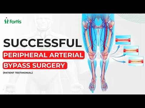 Successful Peripheral Arterial Bypass Surgery (Leg) | Leg Revascularization Surgery MUL