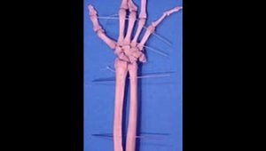 External Fixation of Distal Radius Fractures Using the UMEX Fixator