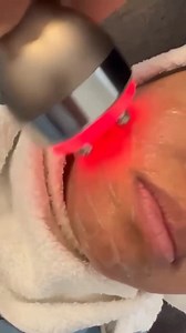 Call it a face-lift if you will (minus the nip and tuck of course ), but our radio frequency treatment on the face really does the most. RF tightens, lifts, contours and takes years off the skin. The heat from the laser penetrates the deep layer of the skin dermis. This stimulates the production of collagen which improves wrinkles and sagging skin. #rftreatment #collagen #aging #smallbusiness #femaleentrepreneur | Neel's Corner | Facebook