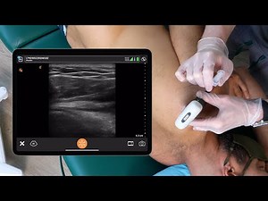 Ultrasound Guided PRP Injection