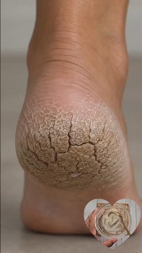 Cracked heels? Try this easy home care routine to help keep your feet smoother and softer #ytshorts