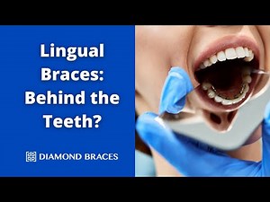 Braces Behind the Teeth? Understanding Lingual Braces