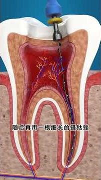 你以为根管治疗就是“杀神经”？错！看完你比很多牙医都懂！3D动画演示 #医学科普 #科普 #中國醫#根管治療