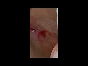 Smelly butt abscess/ big pimple part 2