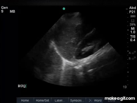 Right Upper Quadrant Neg on Make a GIF