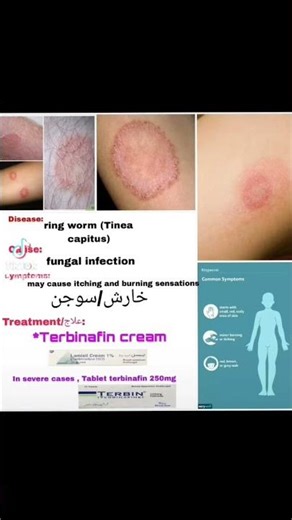 Fungal infection|Ring worm in seconds #skincare #skincaretips #skincareproducts