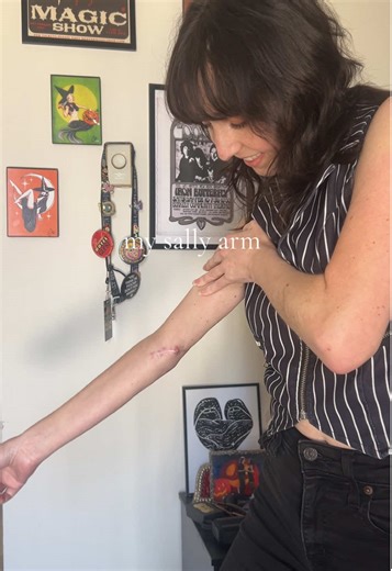 my sister calls this my Sally arm 🪡 this is what is looks like 5 surgeries later