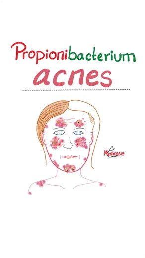 Propionibacterium acnes - Acne Vulgaris - Microbiology #science #microbiology #nurse #doctor #mbbs #medicalstudent #nutrition #pharmacology #learn #dentistry #lab #maths #diet #physicianassistant #neurology #physician #pathology #health #physiology #anatomy #doctors #MCAT #pharmacist #science #education #mcat #chemistry #biochemistry #paramedic #nurse #nurselife #NCLEX #USMLE #doctor #medical | Medicosis Perfectionalis
