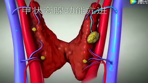 3D动画演示甲状旁腺功能亢进病理，知其然还要知其所以然