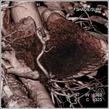 Cardiac: Coronary CTA (1 of 1)