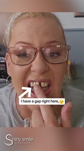 Get the perfect smile, easily and without pain — no drills, no dentist visits! 😀 Save 20% on your snap-on veneers with code SOCIAL20 at checkout. Offer not valid on impression kits. | Shiny Smile Veneers