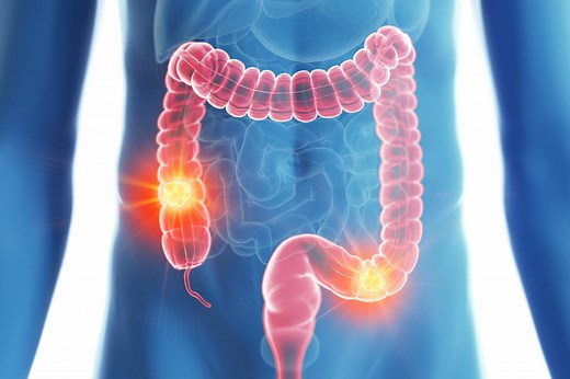 Cancer du côlon : symptômes, causes, stades, comment savoir ?