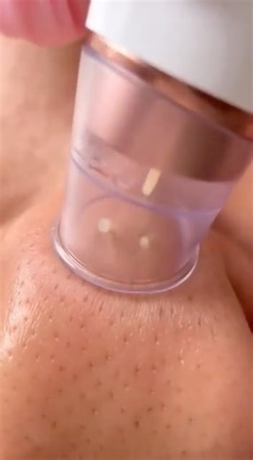 The Most Expensive Blackhead Remover: Is This Pricey Pore Vacuum Worth It? (Shocking Results!)