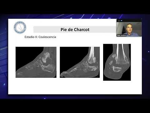 Pie de Charcot. Diagnóstico y manejo en fase aguda