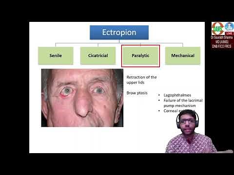 Ectropion: Basics to Surgical aspects