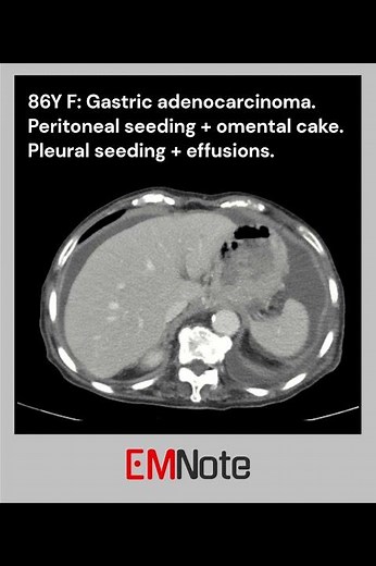 Omental Cake #medical