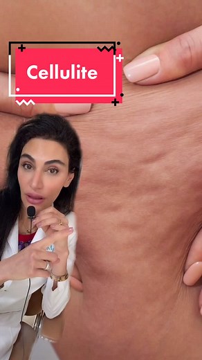 Finally an injection treatment for #Cellulite #dramaticmoments #learnontiktok #drama #dermatology