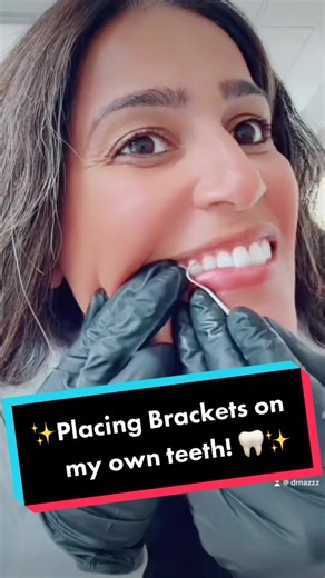 Placing Brackets on My Teeth for Invisalign Treatment