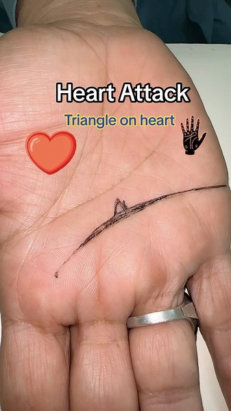 Triangle on heart line predicts heart attack#palmist #palmistry #hand #heart #yousafpalmist | Yousaf Palmist