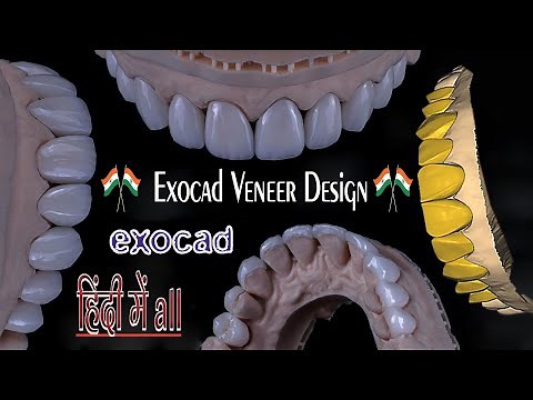 veneer design exocad HINDI & exocad bridge design, exocad smile design,