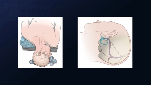 #443: Left Extended Retrosigmoid Craniotomy for Clipping of an Anterior Inferior Cerebellar Artery Aneurysm - All Videos - Seven Series Collection