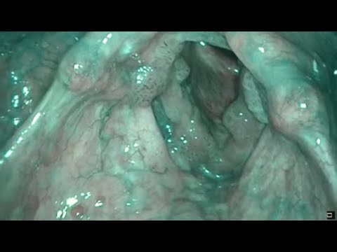 Laryngeal papillomas