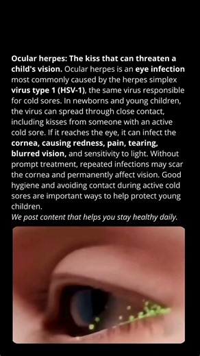 Ocular herpes: The kiss that can threaten a child’s vision.