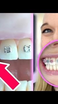 Putting Braces On My Teeth | Which Braces Color Did I Choose?!