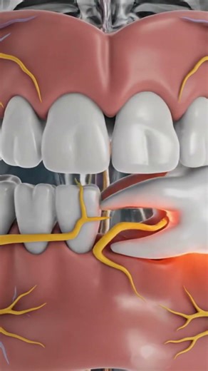 “Sideways Wisdom Tooth Causing Pain See What’s Happening Inside” #3danimation #medicaleducation