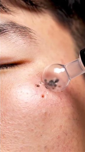 Most Satisfying Pore Cleaning Compilation