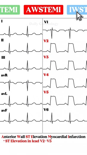 Acute Myocardial Infarction ECG made easy #ecg #cardiology #ecginterpretation #stemi