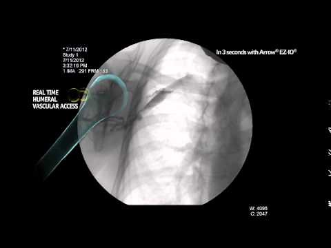 Arrow® EZ-IO® Infusion Fluoroscopy Proximal Humerus (MC-000631)