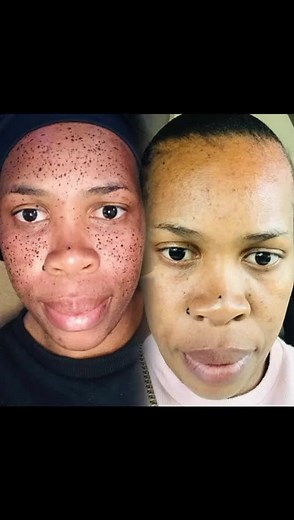Experience safe and effective skin tag removal using the plasma spark method at The Bomb Beauty. Our skilled therapists use a small plasma pen to create controlled sparks on the skin tag's base, causing it to dry up and fall off without affecting the surrounding skin. Take advantage of our 50% special price list for one-time sessions: - Full face: was R3000 now R1500 - Half face: was R1800 now R900 - Full neck: was R3000 now R1500 - Half neck: was R1800 now R900 - Full neck and face combo: Was R