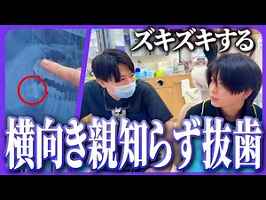【抜歯】横向きの親知らずは早めに抜歯してください！