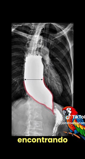 Acalasia: Diagnóstico y Tratamiento en Radiología