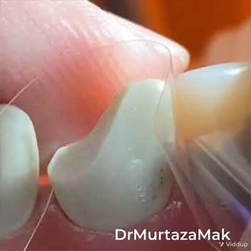 Class IV Composite- Quick 1 minute Tip