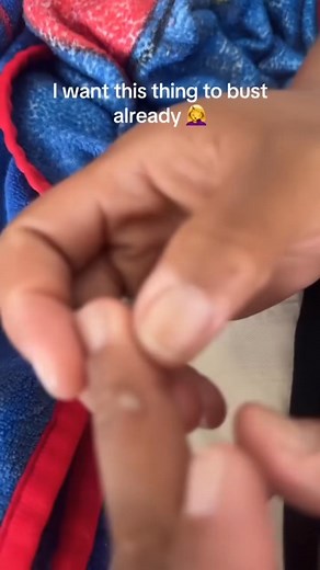 😱 You won't believe what came out of this one... #pimplepop #satisfying | Page 1