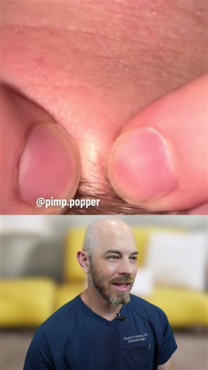 Eyebrow pimple pops are PAINFUL! 😖 (credit: @pimp.popper on TT) #pimple #ouch