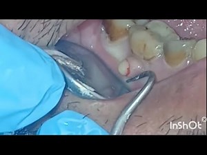 Extreme Tartar Removal & Tooth Abscess Drainage – Dental Procedure Up Close