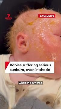 Babies suffering serious sunburn from reflected UV rays